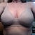 2 weeks post op