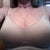 2 weeks post op