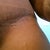 close up of the incision