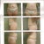 Dr's 4 wk postop pics