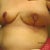 8 days post op