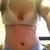 11 day post op