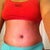 7 day po, scar hidden by underwear
