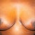 frontal view with zoom on scars 6 weeks post op