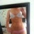 Pre op. body type