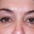 Day 11.  Can you see the deflation.  The exact same circles around my tear trough area that I went in for are back!