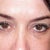 Day 12 most bruising is gone and this is a different angle of my eyes.  The tear troughs look as sunken in as day 11.