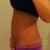 Preop picture 2
