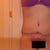 Post Op Day 57 (8 weeks & 1 day)