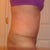 Post Op Day 57 (8 weeks & 1 day)