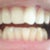 this was a photo taken before i started the invisalign process