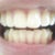 this is a photo taken before starting on my 10th aligner