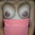 9 days PO...frakenboob on full effect