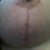 Rt scar (good one)