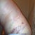 From the side. Swollen POD 4