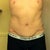 8 weeks post op - showing the incision
