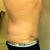 8 weeks post op - showing the incision