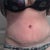 po day 8, with silicone strips on my incision