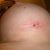 Left breast incision