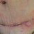 the scar this morning after a shower with Hibiscrub!  I use a fresh wash cloth every wash! this is o my right side as this is taken from a mirror!