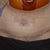 24 Hours Post Op