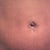 2 weeks using hydroquinone cream (6 weeks post op) and bb tape burn is almost gone completely big improvement cream works