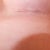 Day 33 Lefty.  You can see the marks from the scar strip.
