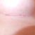 Day 33 Righty.  You can see the marks from the scar strip.