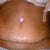 9 days post op tummy tuck scar.....very sad that i still have strech marks but those were all above the bellybutton