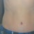 7 Weeks post op