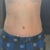 7 Weeks post op