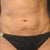 how my tummy looks with tight abs pre-op
