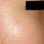 16 months later - Notice around my eyes, the untreated skin is smooth. The rest of my face is destroyed. I only had 1 treatment!! DON'T DO FRAXEL!