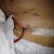 Drainage tube coming out from incision...