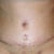 Incision at PO17. the vertical incision was my old BB and now looks like i have 2 BB..