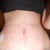 2 weeks post op....still so swollen, i think worse than last week........and yes thats all stretch marks still, not binder marks like a lot of yall...I just had that many that he couldn't even really take a fraction of them....