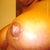 1month post op