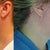 Before and After at 11 weeks post op. LOVE my smooth neck and no more jowels!! Notice how prominent my scars are.
