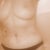 this was taken one month post op....some swelling is still visible