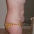 side view before surgery. I had lots of saggy fat!