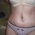 19 days post op. I will update pics at one month post op. 