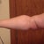 23 dpi. You can see the red at the bottom from the healing and swelling. You can see the tight band of skin at elbow.
