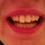 After 36 aligners