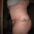 6 weeks Post-Op