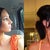 The left side was taken a month after surgery. You can see a little swelling bump on the bridge. Right was taken 1 week ago...the bump is pretty much gone...