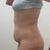 pre-op side