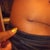 This is my right side incision with my dog ear