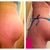 This is a perfect example of fluffing, and weight gain. The picture on the left is at 4 weeks, right after I lost swelling and inflammation. The picture on the right is at 8 months. You can clearly see how I've dropped throughout post-op.