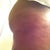 Seven days post op