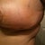 1 wk post op - still extremely swollen and hard in feel